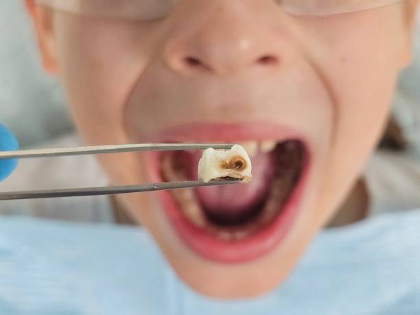 Best Emergency Broken Tooth Repair in Hastings, MN
